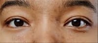 🍊 Can Vitamin C Help Treat Hyperpigmentation? Expert Weighs In